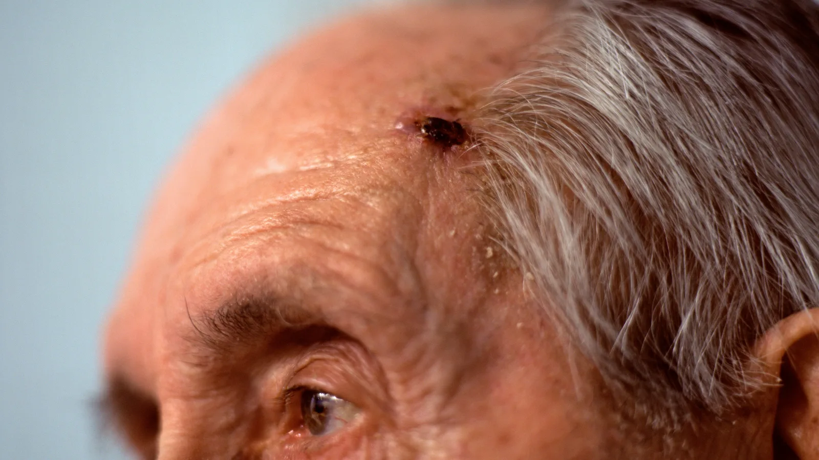 Frueherkennung von Hauttumoren im Gesicht